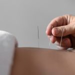 acupuncture